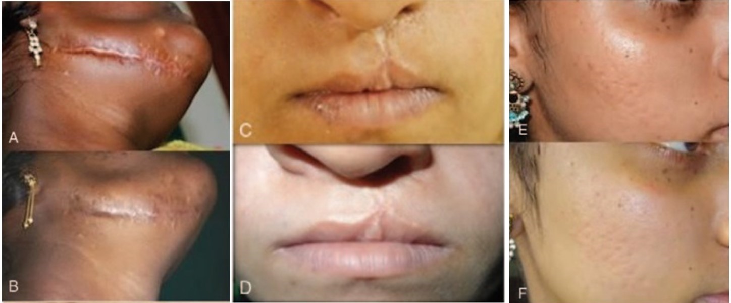 شکل 1 تصاویر بیماران قبل و بعد از درمان که نشان دهنده اثربخشی میکرونیدلینگ در رفع اسکارهای ناشی از جراحی (A و B)، اصلاح شکاف لب (C و D) و آکنه (E و F) است.