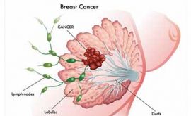 عوامل خطر سرطان سینه | دکتر کتایون کارگر