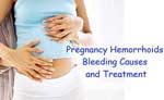 درمان هموروئید در بارداری
