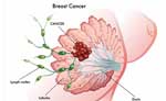 عوامل خطر سرطان سینه | دکتر کتایون کارگر