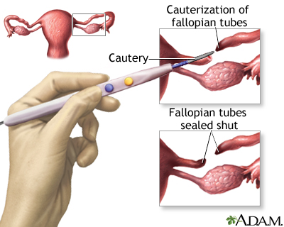female-sterilization-tubal-ligation
