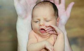 زردی نوزادان | دکتر احمد قاسمیان
