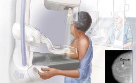 ماموگرافی های تشخیصی نتایج مثبت کاذب بیشتری دارند