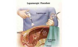 لاپاراسکوپی، جراحی لاپاراسکوپی | دکتر لیلا قائدیان