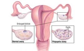 آندروژن در زنان | دکتر فرشته رستم نژاد