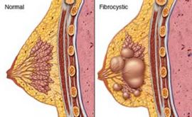 فیبروکیستیک سینه چیست؟