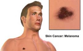 کارسینومای سلول سنگفرشی، نوعی سرطان پوست