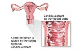 عفونت های قارچی واژن زنان