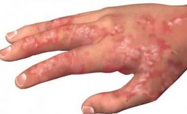 عفونت های پوستی رایج
