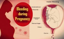 خونریزی در بارداری نشانه چیست؟