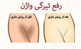 رفع تیرگی واژن با لیزر | دکتر شیرین شمس