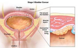 درمان سرطان مثانه | دکتر ساسان محرابی