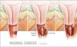 سرطان واژن چیست؟ | دکتر سکینه قربانی