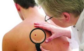هیدروکلروتیازید و افزایش خطر ابتلا به سرطان پوست