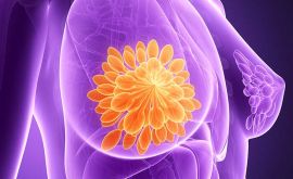 دانسیته پستان می تواند شاخصی برای ریسک سرطان سینه باشد