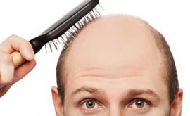 کاشت مو - کاشت مو چیست؟ | دکتر حمید وحیدی