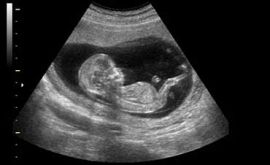 فواید سونوگرافی جنین در بارداری