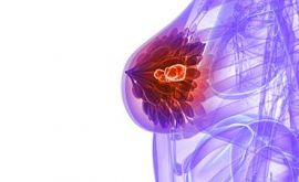 داروی تراستوزومب برای درمان سرطان سینه و معده تایید شد